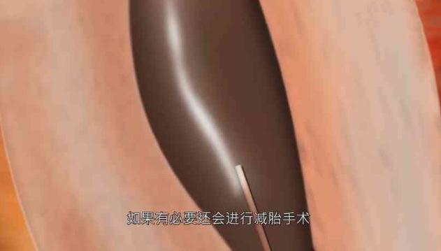 试管婴儿痛苦大吗(试管婴儿3D模拟图全过程)