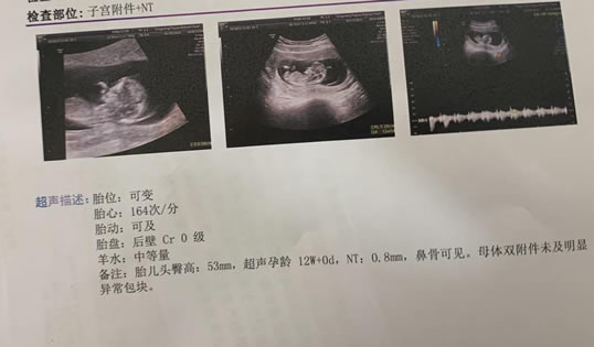 怀孕12周nt值1.3mm是男孩女孩(真实案例)