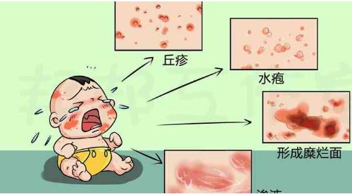 湿疹和热疹的区别图片,外貌症状皆不相同一眼便可分别