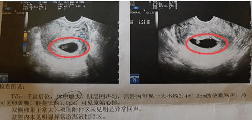 孕早期B超检查主要有哪些内容(B超单子看男孩女孩方法)