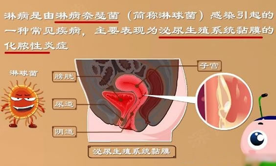 什么是花柳病图片是什么样子(花柳病简介)