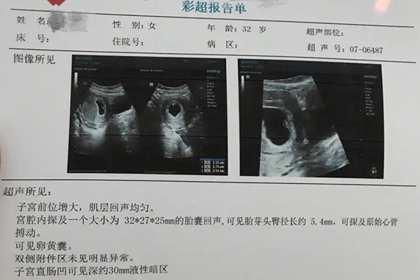 长孕囊和圆孕囊的区别 孕囊长是男孩圆是女孩准不准