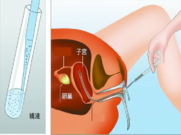 盘点做供精人工授精需具备的条件,适不适合做看完就知道