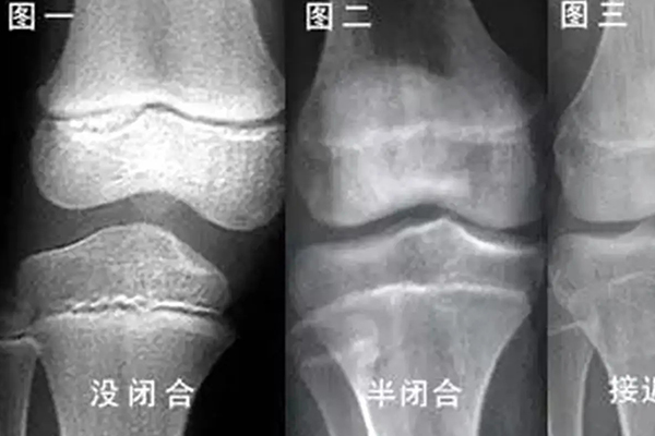 8个征兆说明停止长高(骨骺线闭合是否说明不长高了)