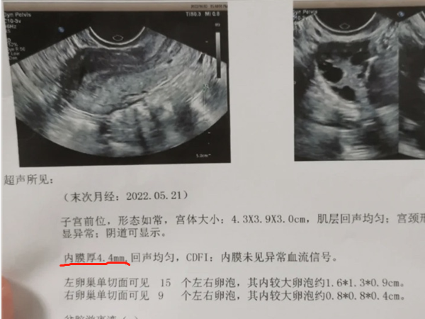 子宫内膜厚4.4mm是什么状态？