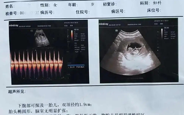 b超看性别的技巧(做B超看性别准确率高不高)