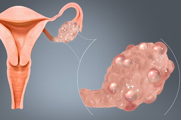 中医能否三个月治好多囊卵巢(多囊卵巢中医治疗方法)