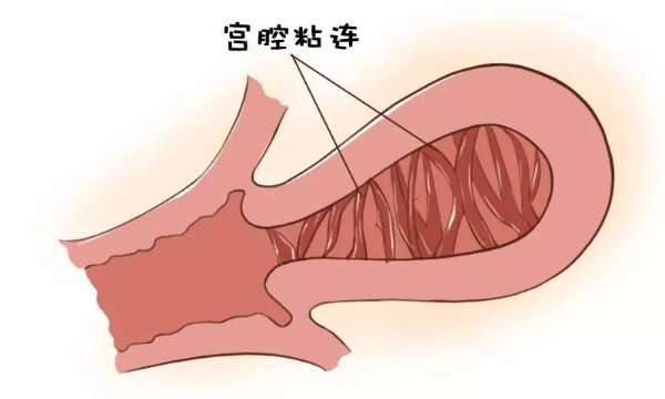 治疗宫腔粘连费用(什么是宫腔粘连)