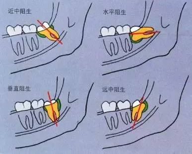 智齿在哪个位置图 智牙什么样子的图片