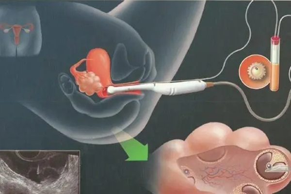 人工取卵的全部过程(试管人工取卵疼不疼)