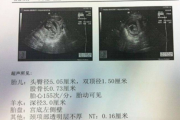 孕囊数据判断胎儿性别很准(生男孩胎囊数据分享)