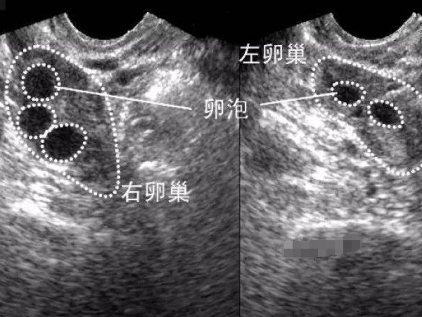 空卵泡能不能取出来 是否可以做试管？