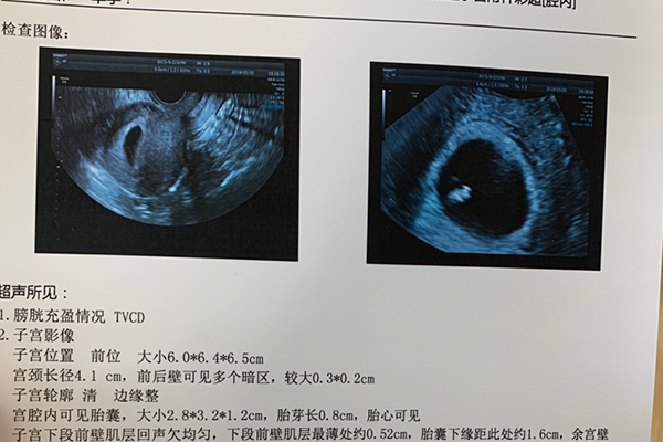 7周胎芽大小判断男女(生男生女宝妈经验分享)