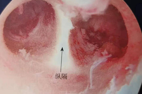 宫腔粘连自愈的秘诀 女性宫腔粘连治疗方法