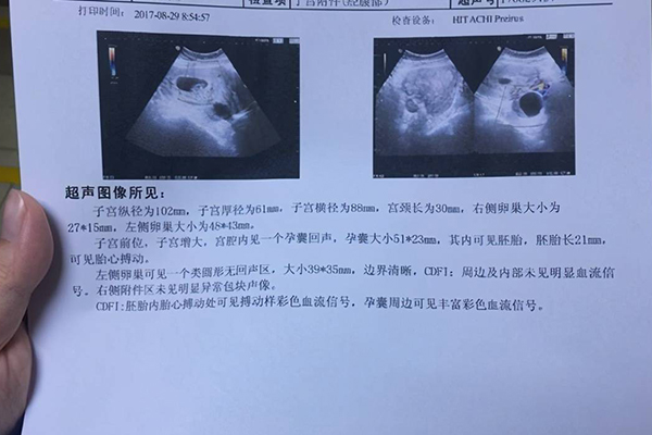 6个月b超三条线但生了儿子是怎么回事