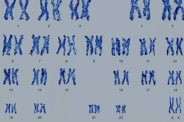 18p四体综合征是什么意思 染色体18四体综合征的表现