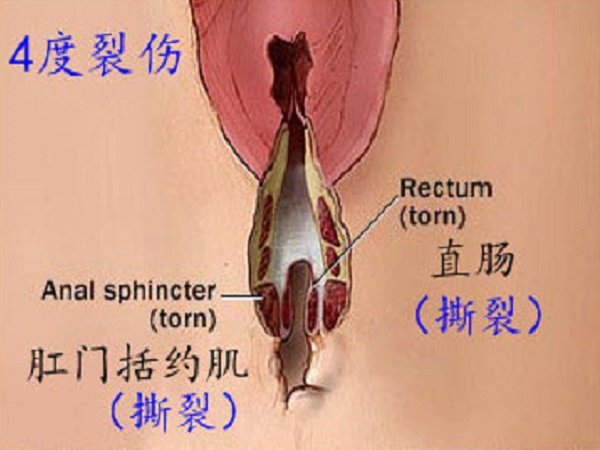 怎么知道自己几度撕裂(附一到四度撕裂伤示意图)