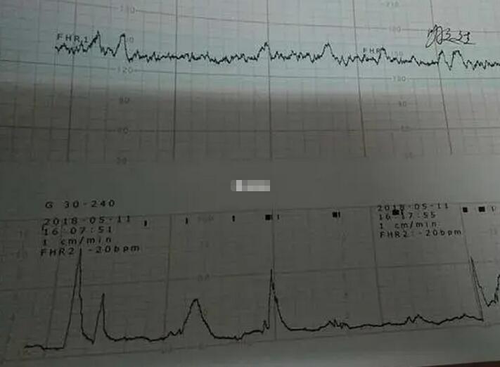 前壁和后壁哪个顺产疼(怀孕前壁累还是后壁累)