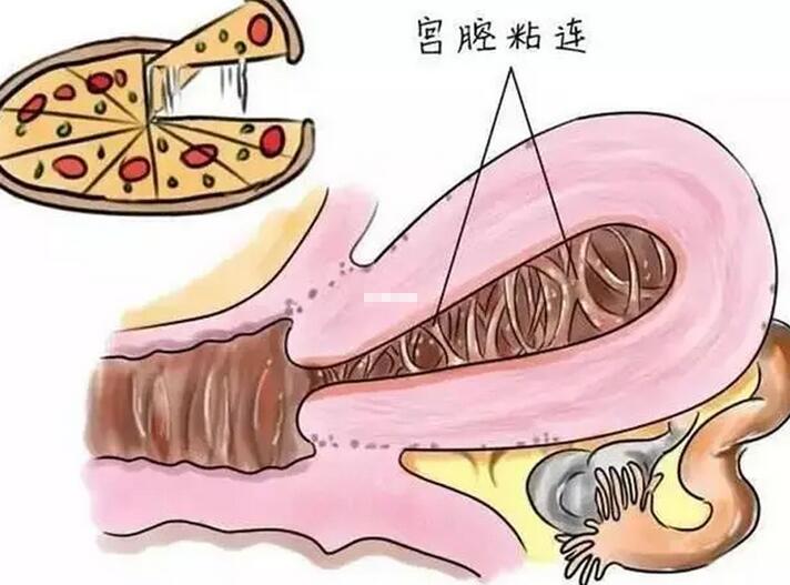 宫腔粘连会自愈吗(宫腔粘连三种保守治疗)