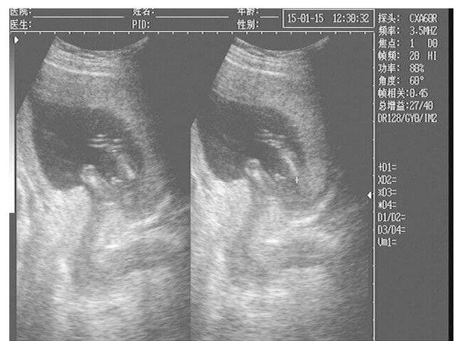 子宫前位有什么症状(子宫前位判定标准和检查诊断方法)