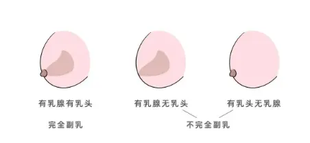 副乳也会分泌乳汁吗(副乳如何消除)