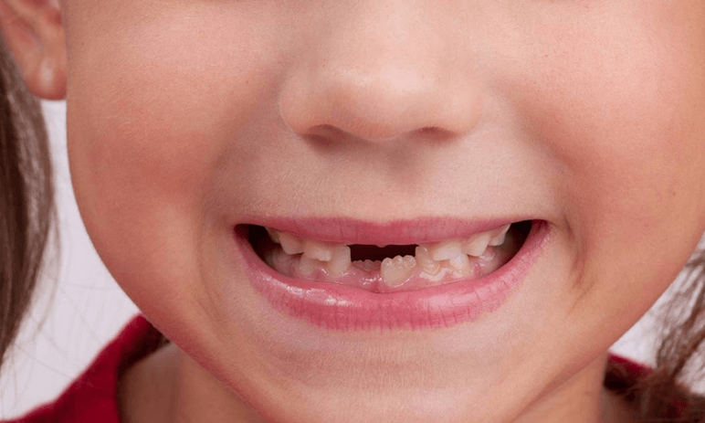 儿童牙齿换牙顺序(乳牙换牙顺序)