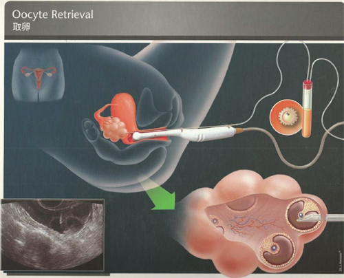 做试管婴儿取卵的危害有什么(取卵一次对身体危害大不大)